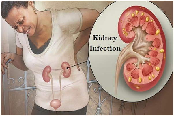 Kidney Infection Treatment: Expectations & Management