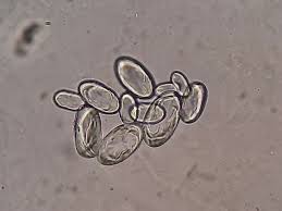 calcium oxalate crystals in urine