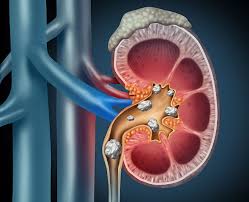Kidney Stones: Causes, Symptoms, Diagnosis & Treatment