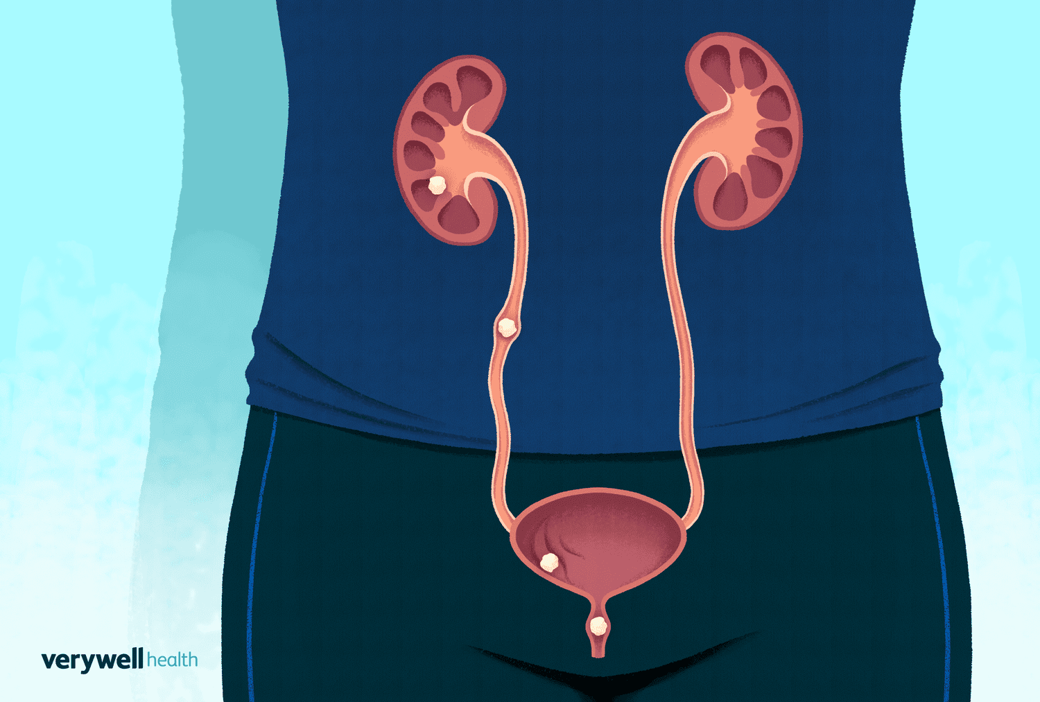 Passing Kidney Stones: Symptoms, Pain Relief & Care