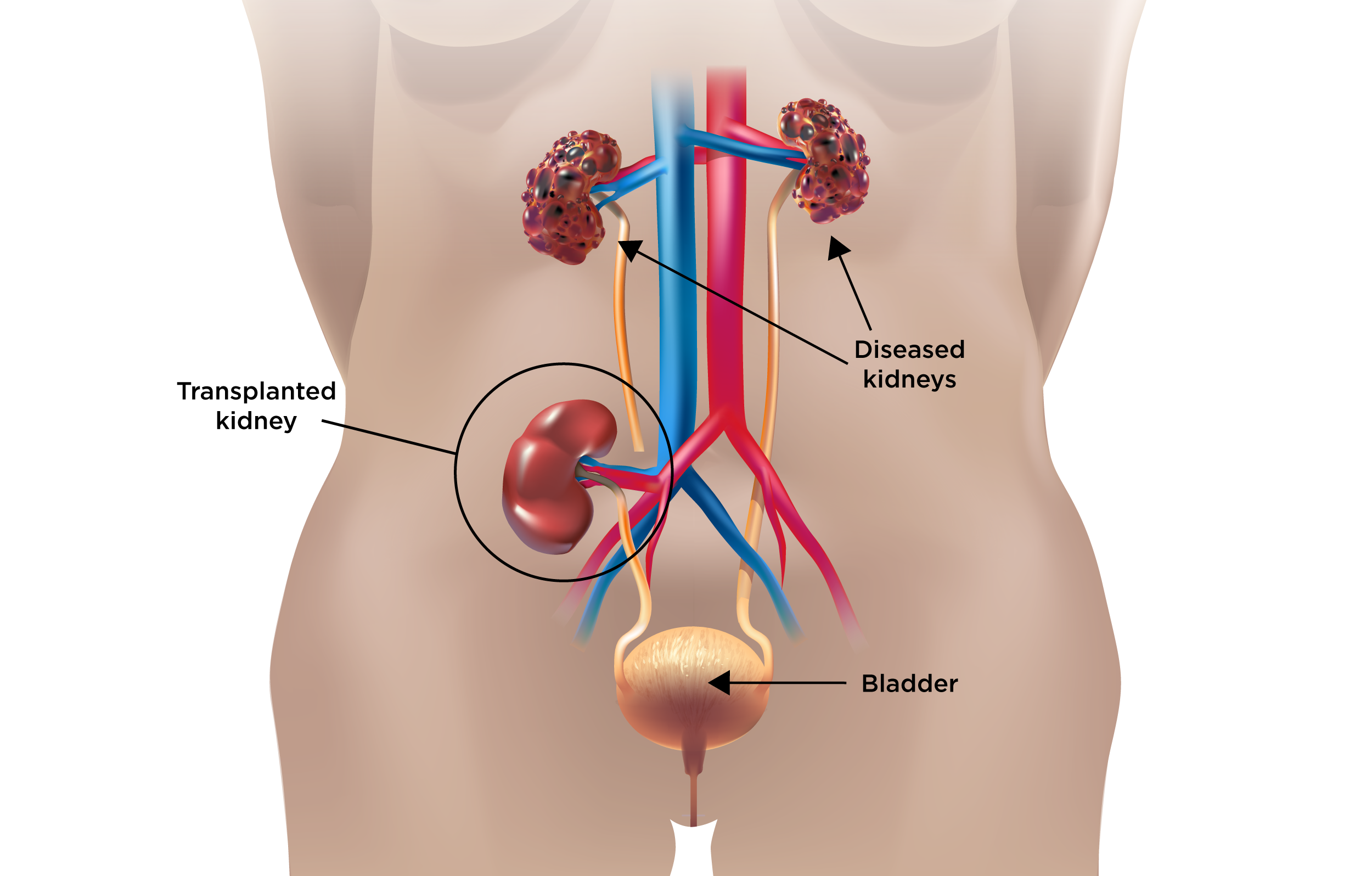 Kidney transplant waiting list by state