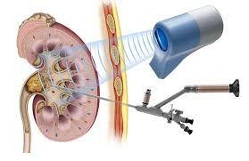 laser treatment for kidney stones