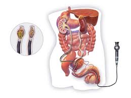 laser surgery for kidney stones