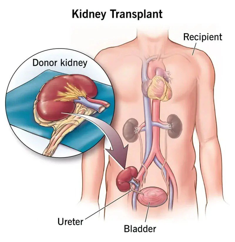 How to get kidney for transplant in India