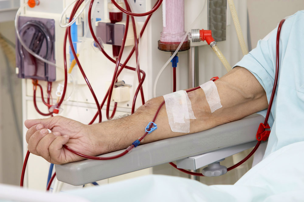 Dialysis Treatment: Supporting Kidney Function in Failure