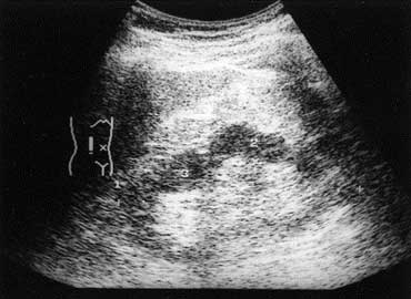 Chronic Renal Insufficiency