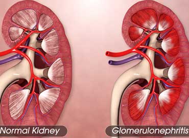 Glomerulonephritis