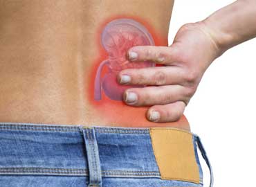 Kidney Stones