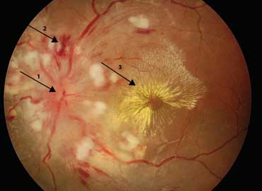 Malignant Hypertension